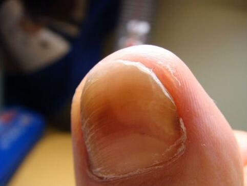 怎么做好预防灰指甲传染呢