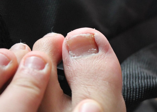 详解治灰指甲需要多少钱 灰指甲治疗方法有哪些