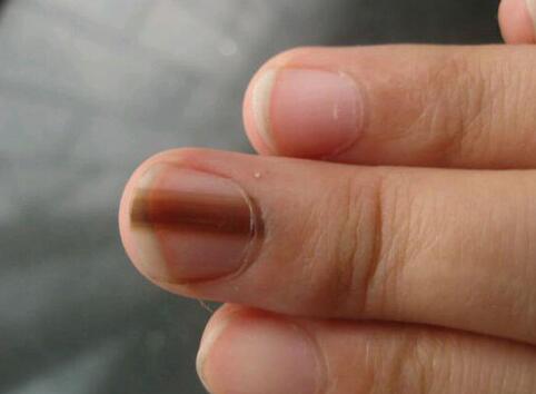 灰指甲的预防方法有哪些