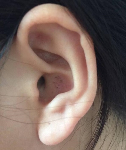 耳鸣的形成以及诊断的方法