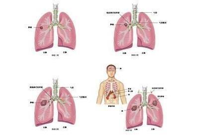 肺癌的四种病理类型 肺癌的临床及治疗方式