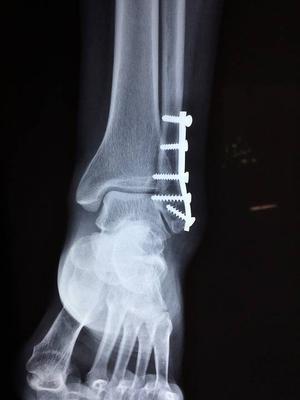 踝关节扭伤一年才好 踝关节扭伤后的注意事项
