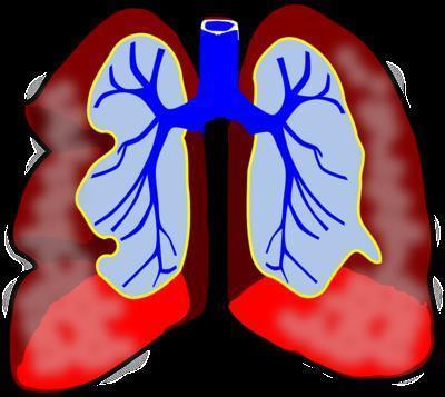 治疗肺气肿喷雾剂 导致肺气肿的原因