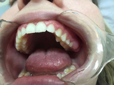 慢性牙龈炎是癌症吗 什么是慢性牙龈炎