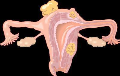 子宫息肉白带有血丝怎么治疗 子宫息肉的诱发病因有哪些