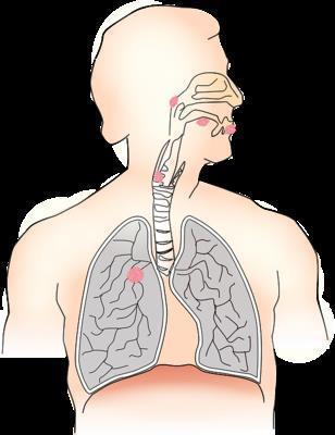 肺结核阴性会不会传染 肺结核的临床表现有哪些丫