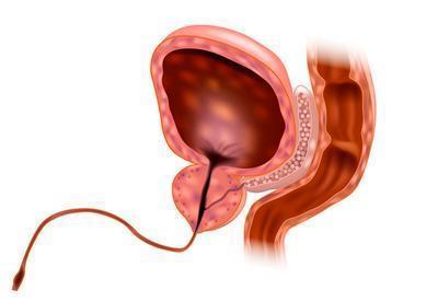 男性膀胱炎发热尿潴留很严重吗 介绍治疗膀胱炎的药物