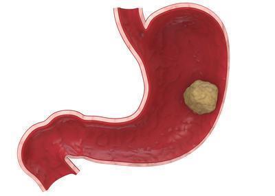慢性胃炎能吃益生菌吗 慢性胃炎要检查什么