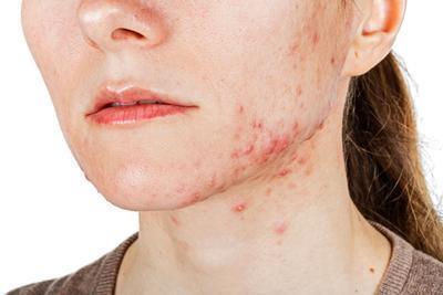 癣菌疹和汗疱疹区别是什么 汗疱有哪些饮食禁忌