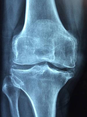 骨关节炎用药治疗的误区有哪些 骨关节炎的治疗方法有哪些呢