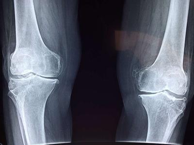 膝关节肿胀怎么办 膝关节肿胀的鉴别诊断