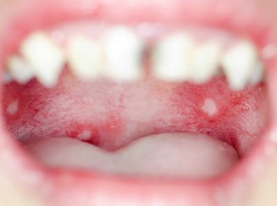 口腔溃疡补充维生素c管用吗 口腔溃疡吃什么水果缓解