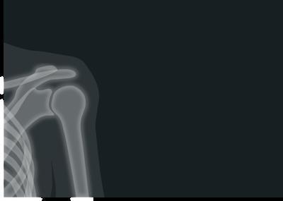 右肩锁骨骨折要手术好还是中医保守治疗好呢 右肩锁骨骨折的并发症有哪些