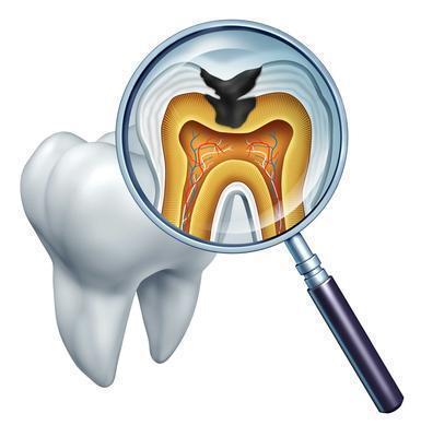 牙髓炎补牙 牙髓炎是什么有哪些症状