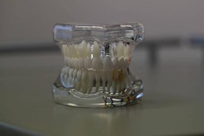 补牙牙套的作用 补牙有什么材料