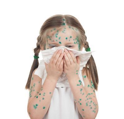 小孩麻疹怎么治疗 小孩麻疹的病因