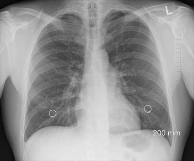 术后肺不张的护理措施有哪些 肺不张的原因有哪些