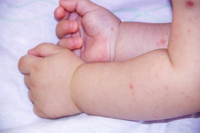 宝宝手指狭窄性腱鞘炎怎么办 腱鞘炎可以分为哪些类型