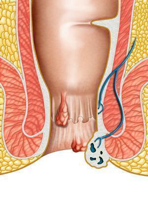 前列腺癌从肛门检查 前列腺癌的检查项目有哪些