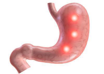 胃癌手术胃漏应该怎么办 胃癌手术胃漏的日常护理