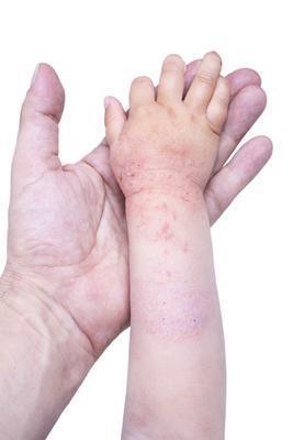 抽血能检查出荨麻疹吗 荨麻疹的典型症状