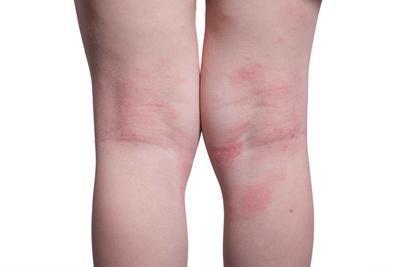 膝盖磨损严重的表现有哪些 膝盖磨损严重怎么治疗