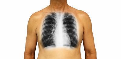 小儿肺炎呼吸衰竭 肺炎呼吸衰竭如何治疗