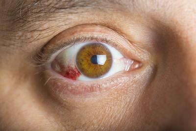 红眼病会不会口水传染 红眼病的原因都有哪些