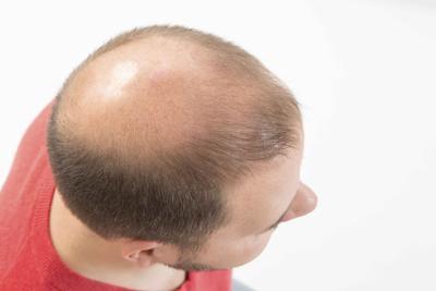 斑秃长出毛囊算好转吗 早期斑秃的症状有什么呢