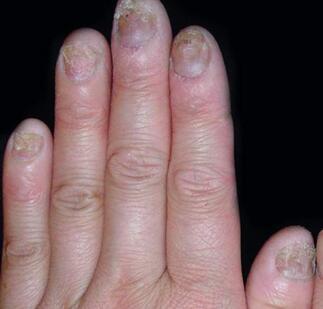 怎样才知道自己患了灰指甲