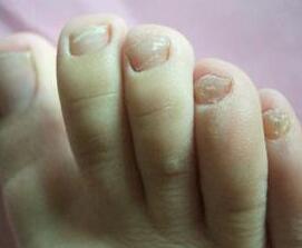 灰指甲早期症状表现有哪些呢