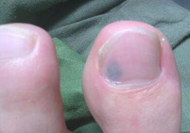 灰指甲的发病受哪些因素的影响