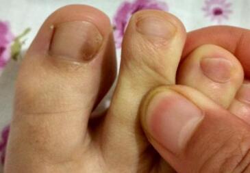 灰指甲患者的生活带来的影响