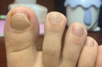 灰指甲初期会有哪些症状