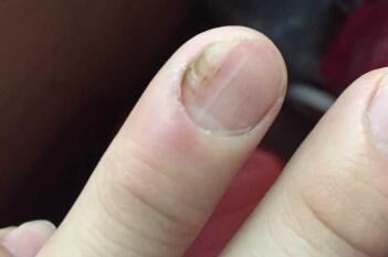 灰指甲有哪些具体的危害