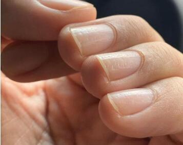 灰指甲会带来哪些不良的并发症