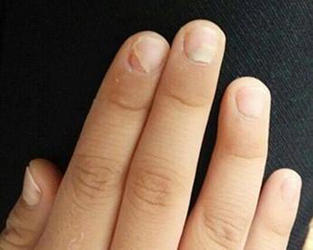 灰指甲的常见临床类型有几种