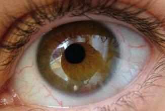 预防青光眼的相关办法有哪些呢