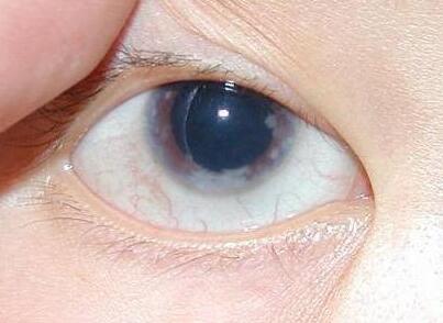 青光眼疾病的类型到底会是什么呢