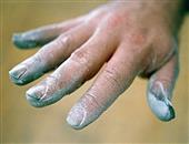 白色念珠菌感染的指甲是什么症状 如何治疗灰指甲