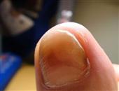灰指甲的初期症状有哪些?