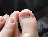 详解治灰指甲需要多少钱 灰指甲治疗方法有哪些
