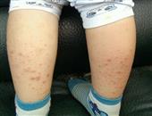 腿部皮膚過敏怎么辦？皮膚過敏的原因_皮膚過敏會給人體帶來哪些危害