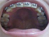 长智齿牙龈肿痛怎么办长智齿会有哪些危害