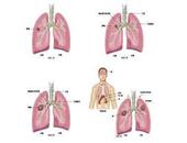 肺癌的四种病理类型 肺癌的临床及治疗方式