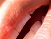 牙龈发炎可以去洗牙吗 牙龈发炎的治疗方法