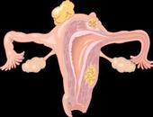 单纯的宫颈白斑要注意什么 3个日常护理方法介绍