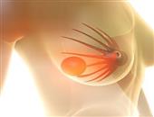 前列腺癌如何避免转移 前列腺癌转移后如何治疗