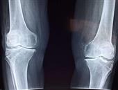 月骨脱位复位手法的步骤有哪些 月骨脱位的疾病概述