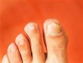 脚指甲凹凸不平怎么办 如何保持脚趾甲的光滑